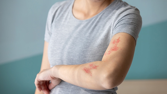 生蛇2026-症狀成因-後遺症及預防全攻略-蛇針保護力及精選接種方案